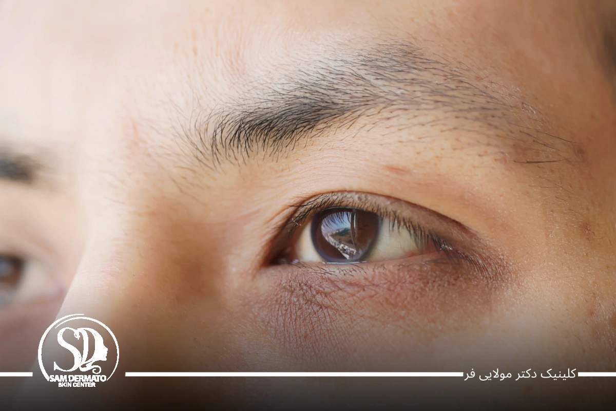 برطرف کردن سیاهی دور چشم