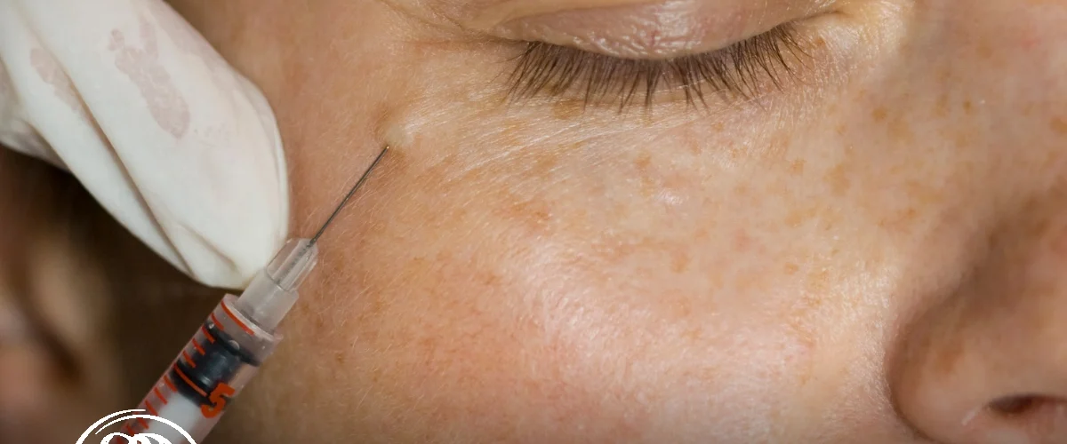 برطرف کردن سیاهی دور چشم