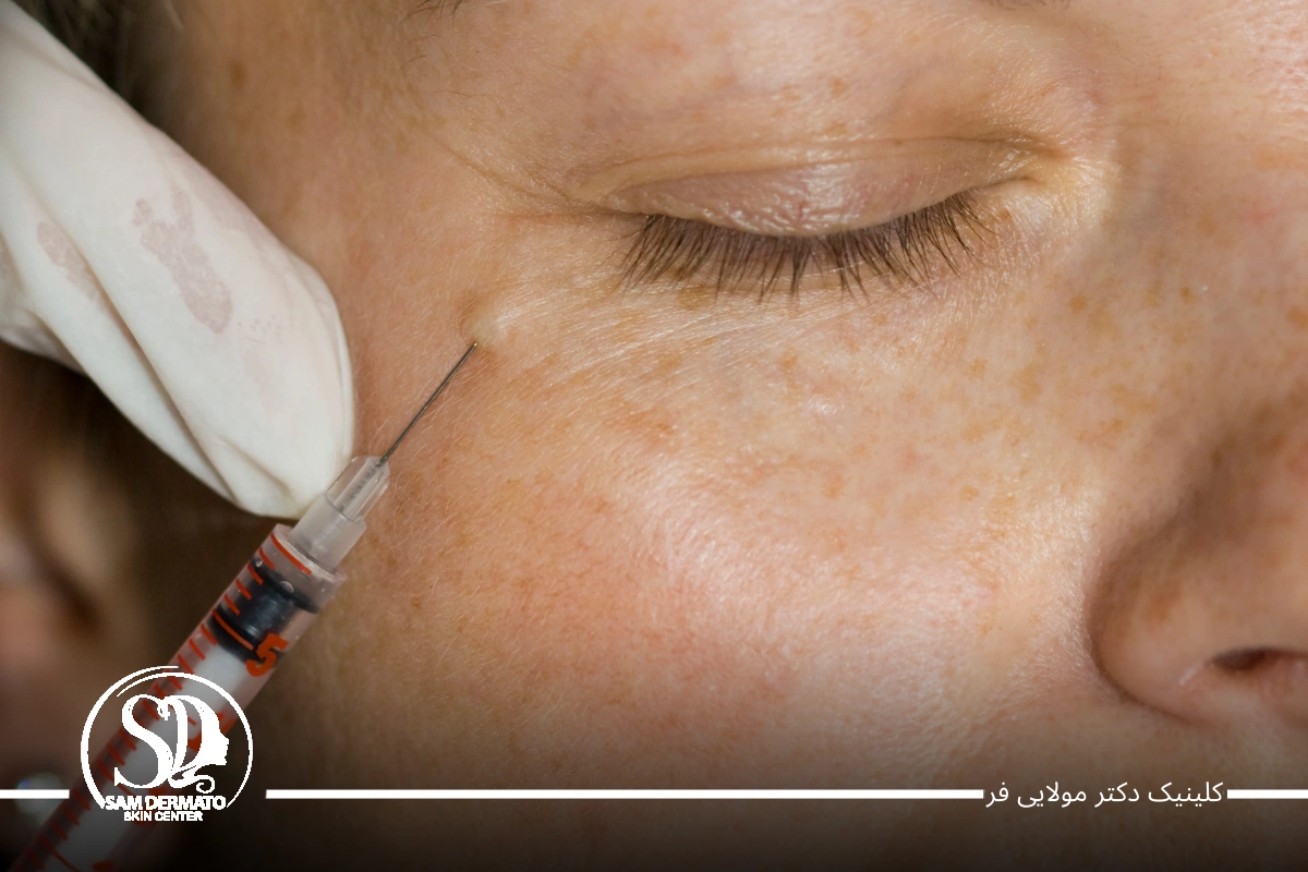 برطرف کردن سیاهی دور چشم