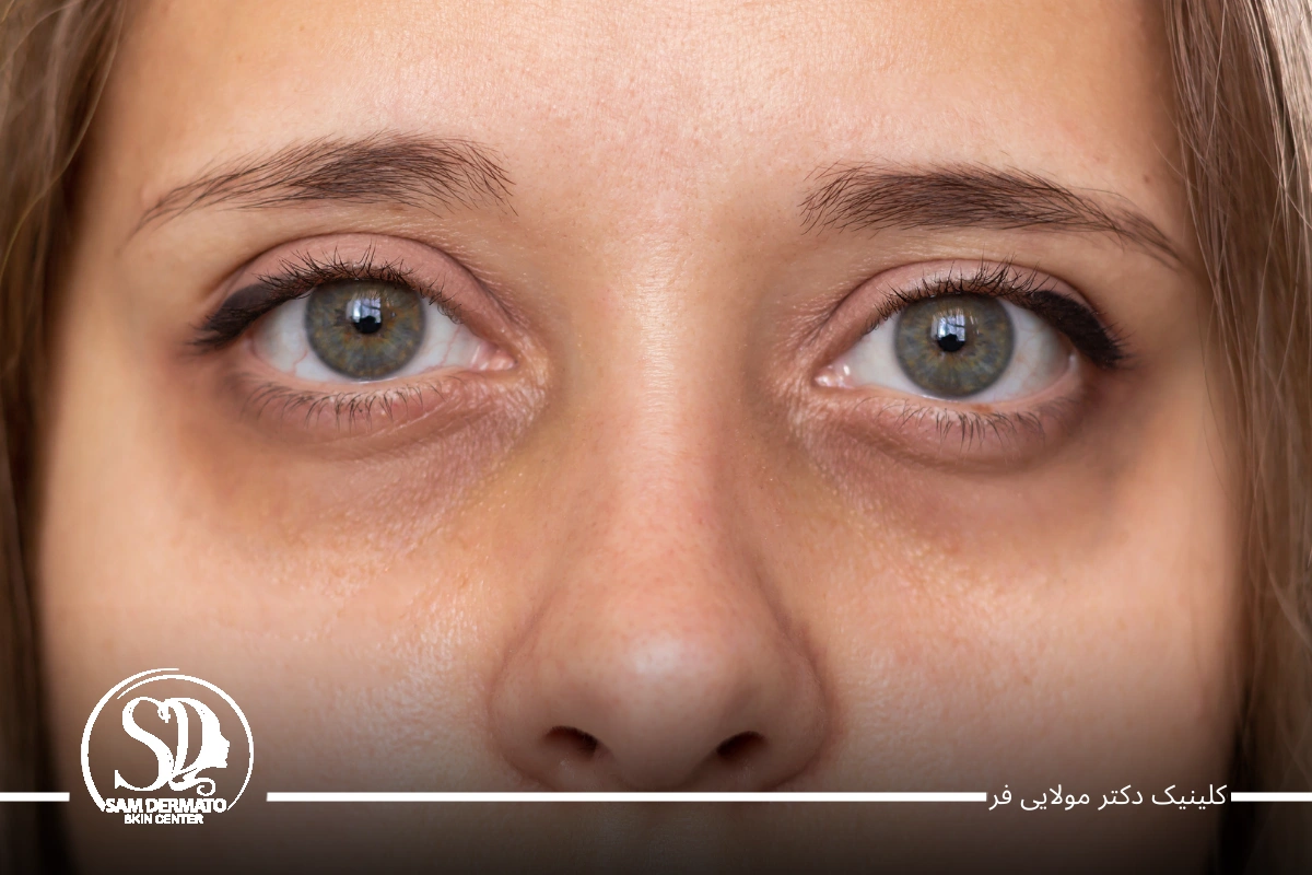 مزوژل زیر چشم