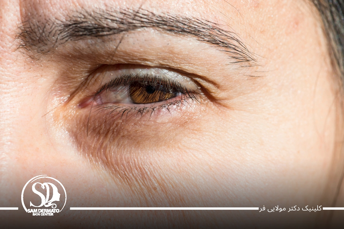 مزوژل زیر چشم