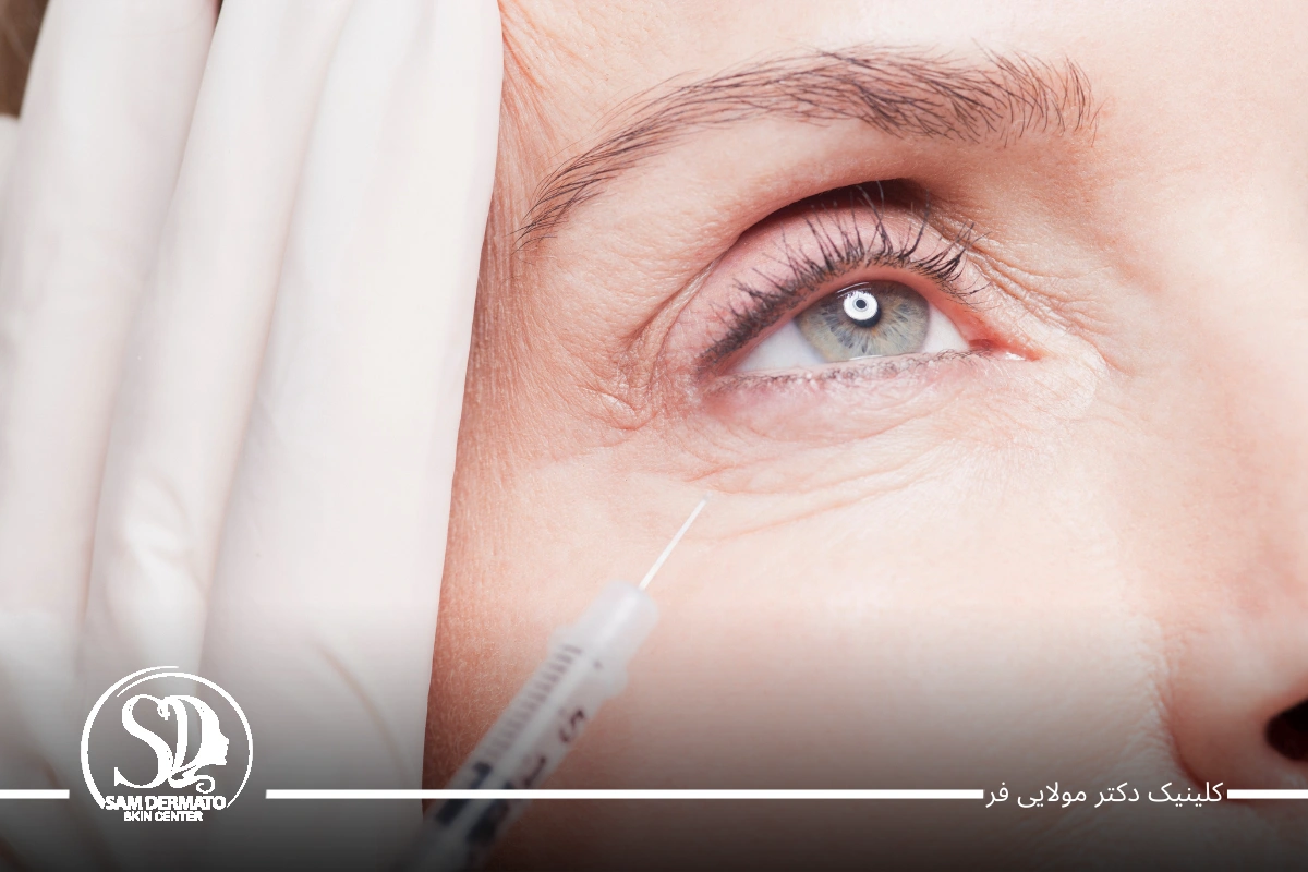 مزوژل زیر چشم
