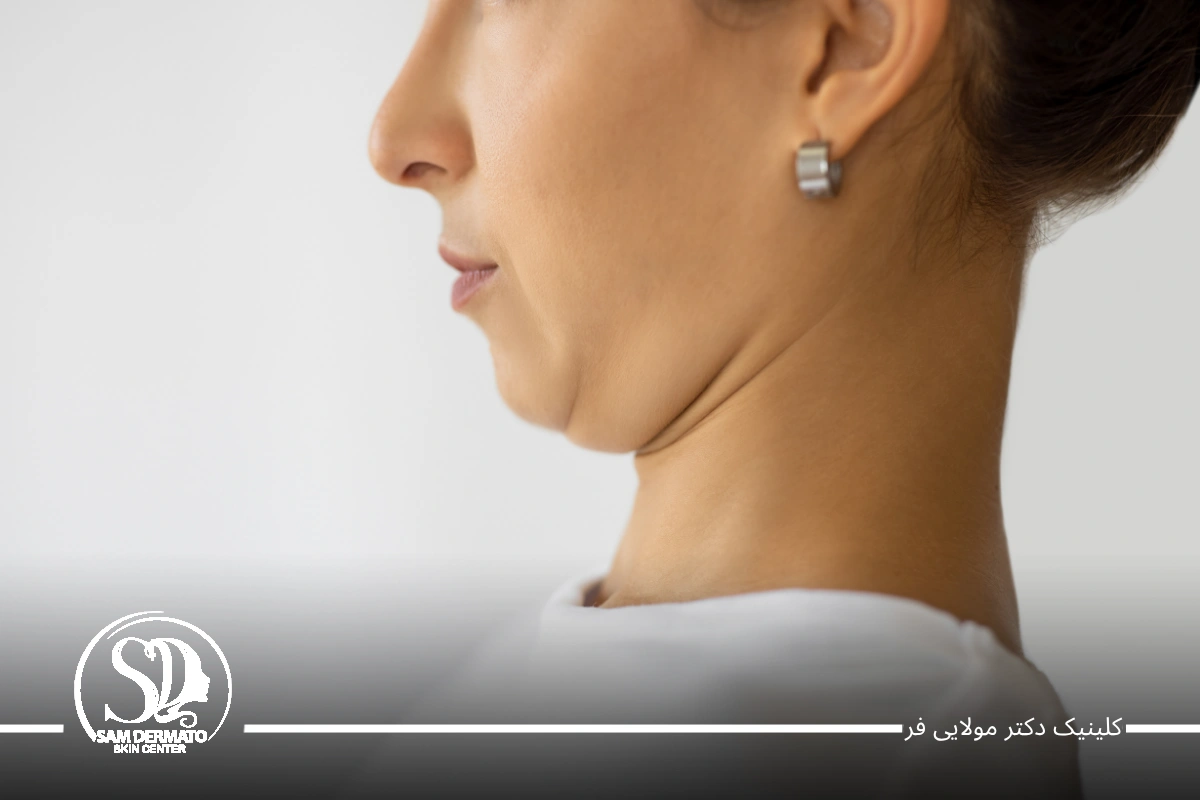 آر اف غبغب چیست