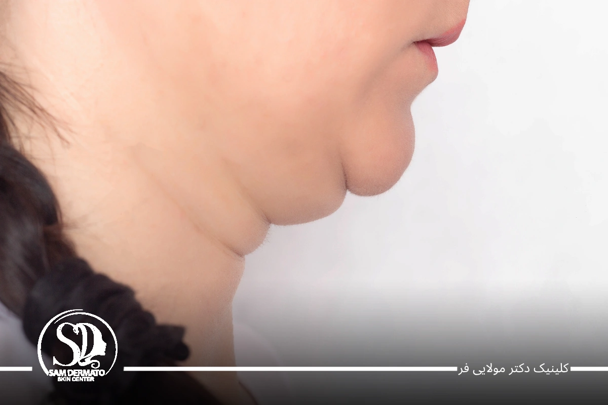 بهترین دستگاه‌ رفع غبغب