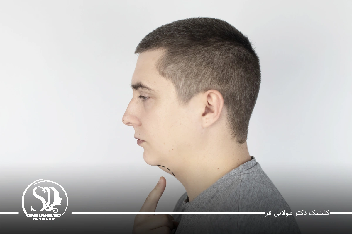رفع دائمی غبغب