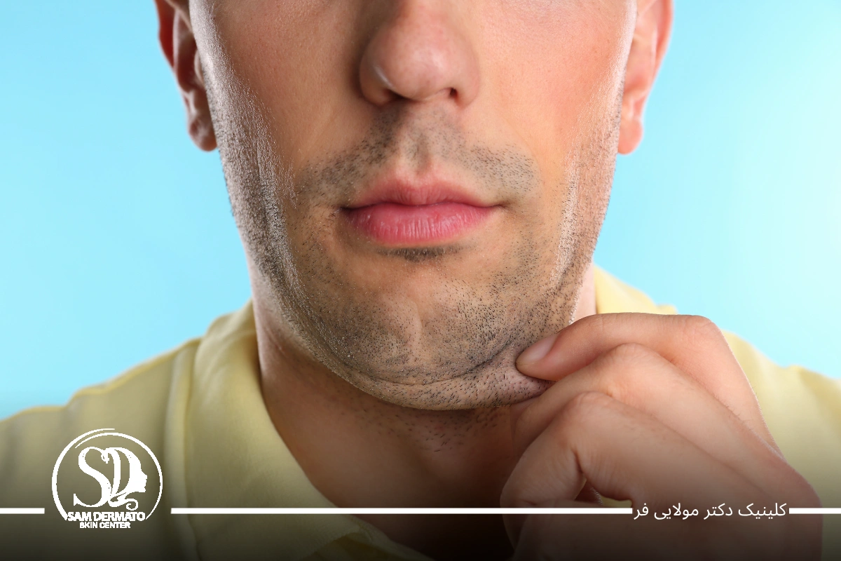 سریعترین راه رفع غبغب