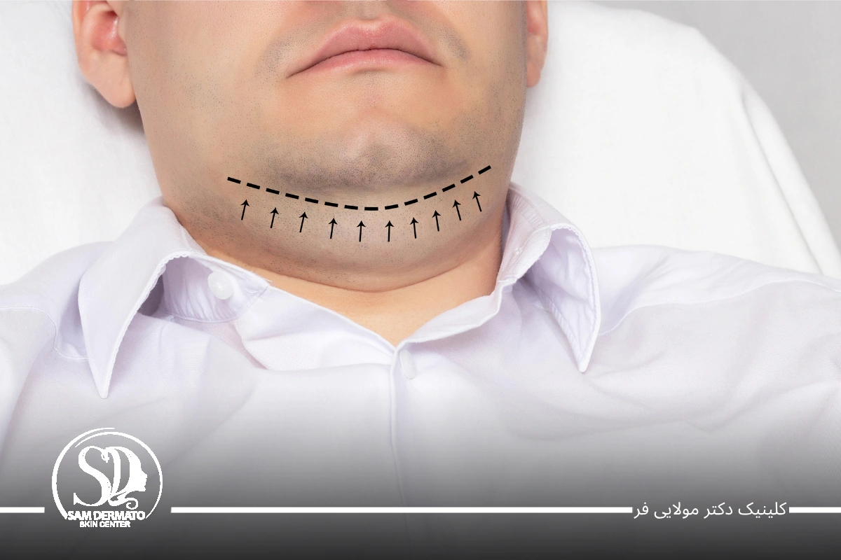 سریعترین راه رفع غبغب