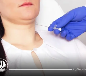 لیفت غبغب با نخ