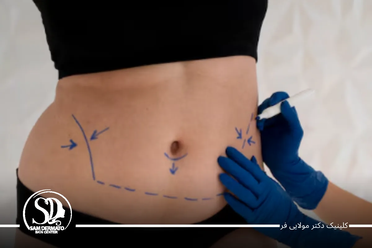 اندولیفت برای چه کسانی مناسب است؟