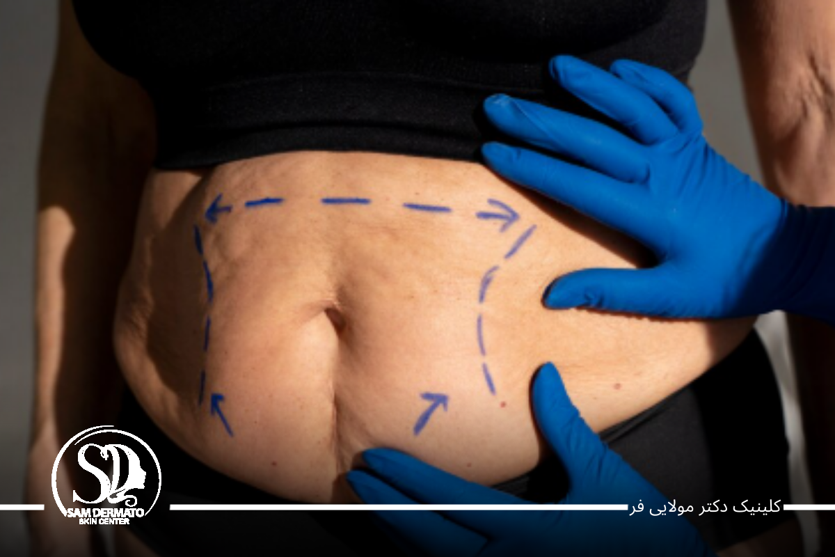 اندولیفت؛ بی ‌رحم ‌ترین چربی‌ سوز شکم و پهلو بدون جراحی