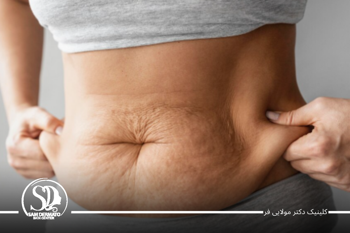 اندولیفت؛ سریع ‌ترین راه لاغری شکم و پهلو بدون جراحی