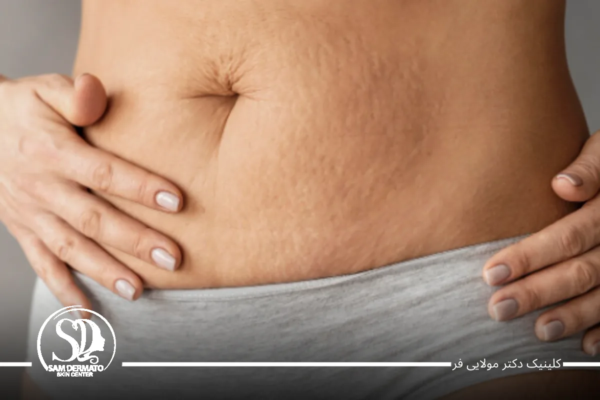 روش‌های مؤثر برای شکم لاغری سریع در ۳ روز