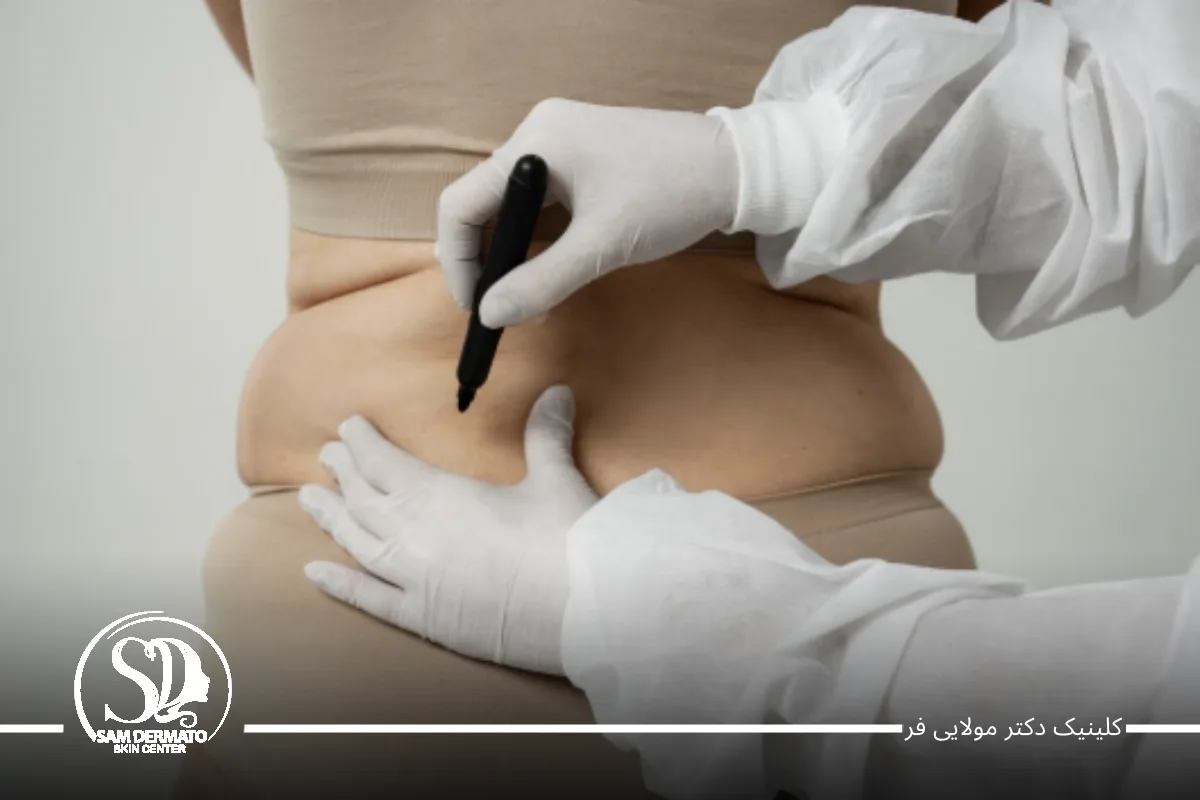 ماندگاری اندولیفت