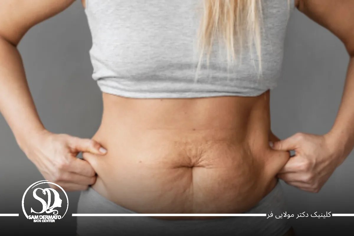 مزوتراپی لاغری
