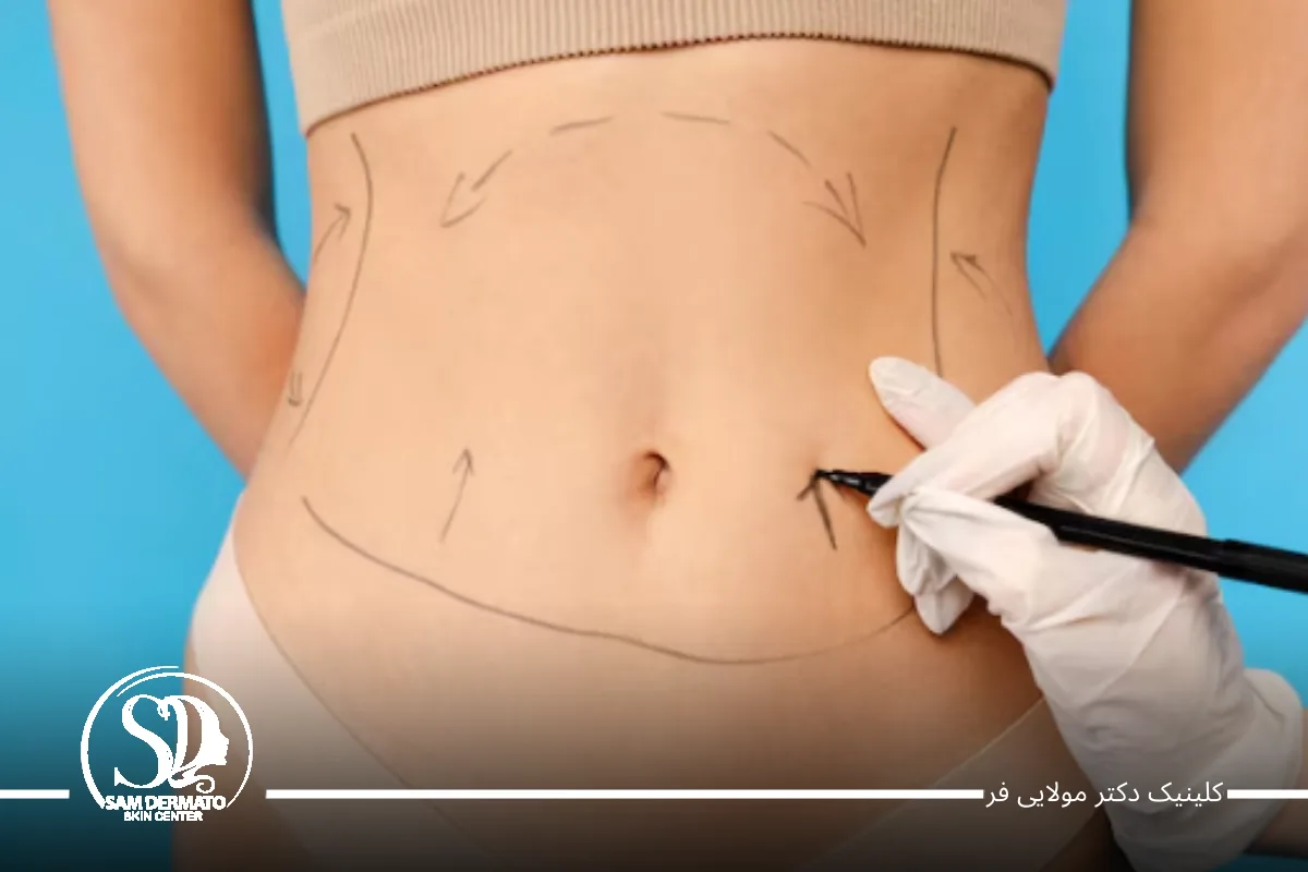 چه دستگاه‌هایی برای چربی سوزی شکم وجود دارد؟