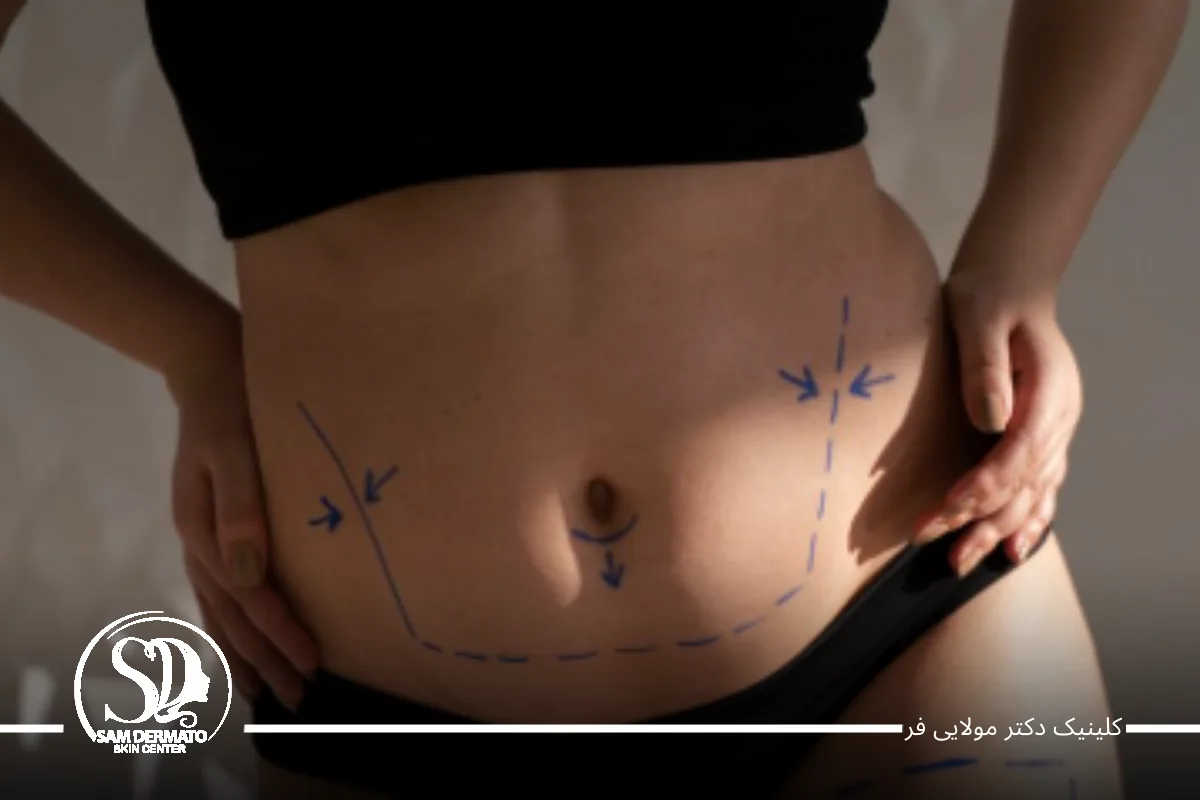 ۵. EMS و دستگاه‌های عضله‌ساز – تقویت و فرم‌دهی عضلات شکم