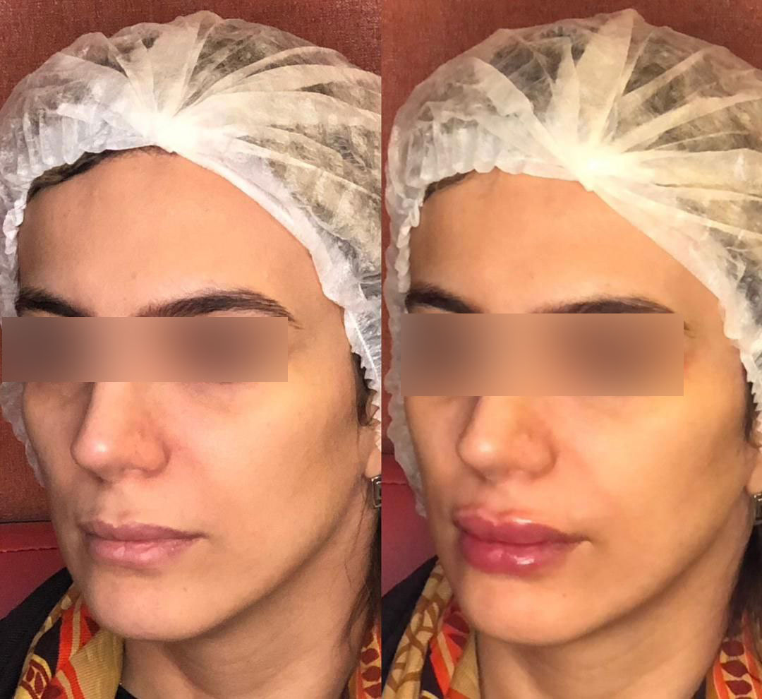 تزریق-ژل-لب-روسی