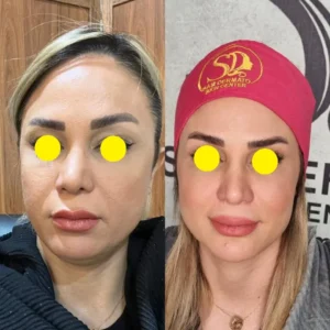 نمونه اول مقایسه قبل و بعد اندولیفت صورت