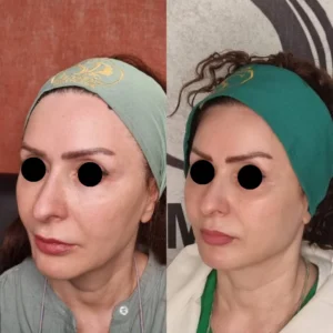 نمونه دوم مقایسه قبل و بعد آندولیفت صورت