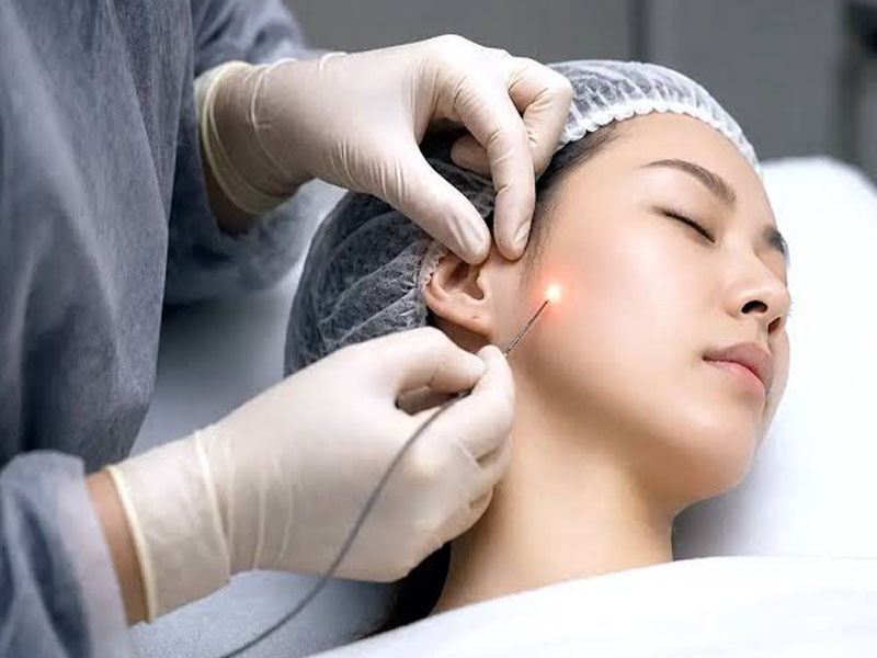اندولیفت مناسب چه سنی است؟ 5 نکته مهم درباره بهترین سن 1 اندولیفت برای چه کسانی مناسب است؟