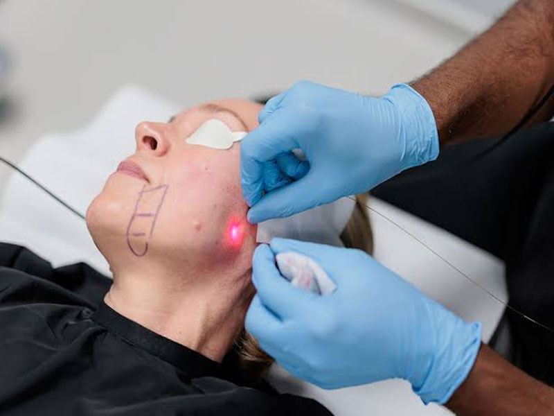 اندولیفت مناسب چه سنی است؟ 5 نکته مهم درباره بهترین سن 3 عوارض احتمالی اندولیفت
